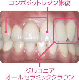 ラミネートベニヤ