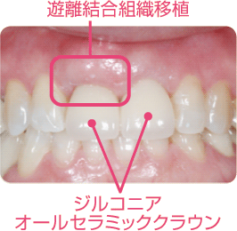 ラミネートベニヤ