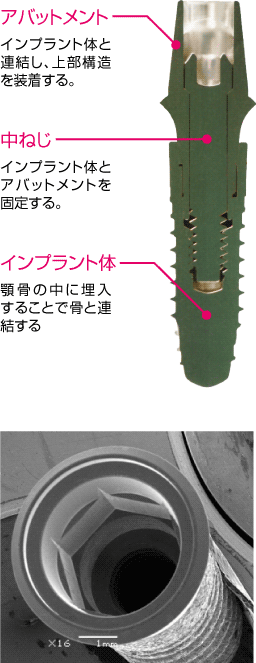 インプラントを共同開発