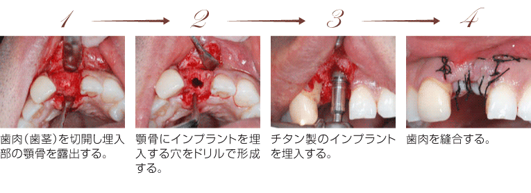 インプラント埋入手術の順番