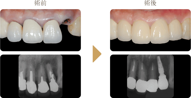 上顎前歯部埋入症例