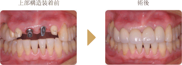 上顎前歯部埋入症例