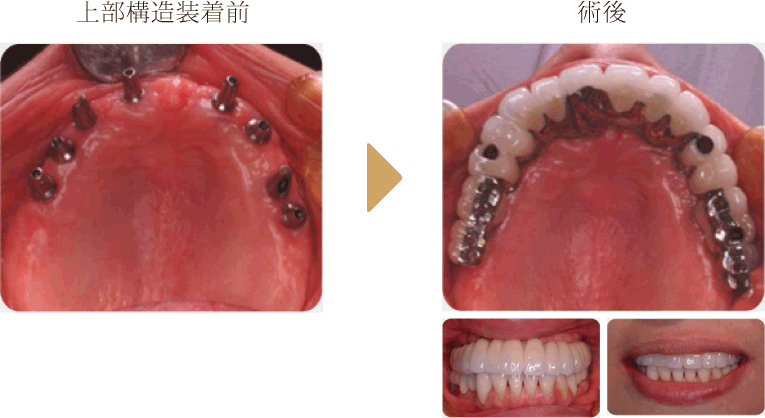 全顎にわたる埋入症例