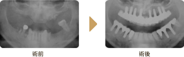 全顎にわたる埋入症例